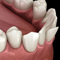 Illustration of crooked teeth
