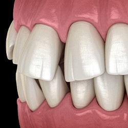 Illustration of gapped teeth