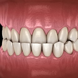 Illustration of an underbite