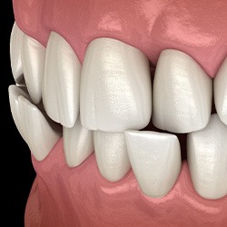 Illustration of a crossbite