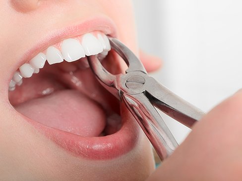 A dentist using forceps to extract a patient’s tooth