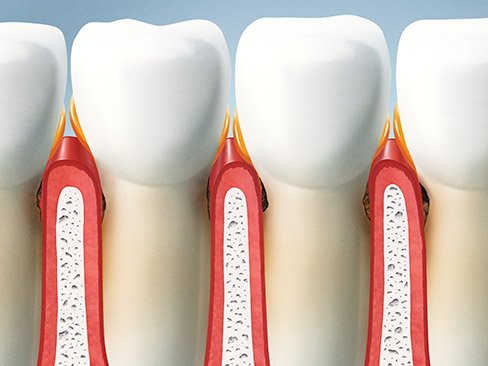Animation of inflamed gums before scaling and root planing