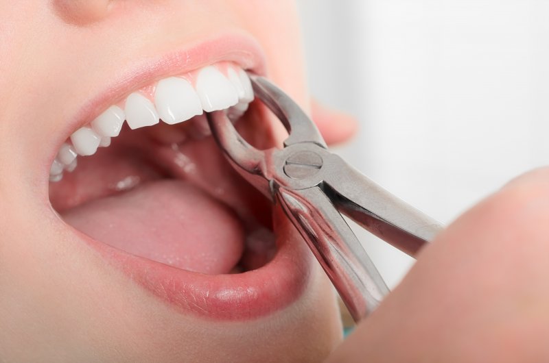 Dental forceps grabbing a tooth in a woman’s mouth